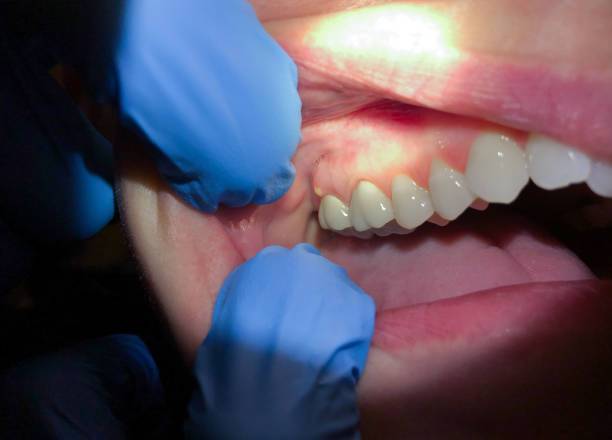 Best Emergency Dental Care for Abscessed Tooth in Idalou, TX